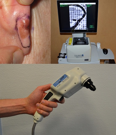 In vivo and ex vivo confocal microscopy for the evaluation of surgical margins of melanoma