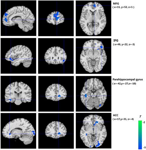 Impaired decision-making and impulse control in Internet gaming addicts: evidence from the comparison with recreational Internet game users