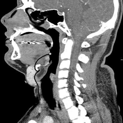 Arrested Descent of the Thyroid: A New Manifestation of Abnormal Thyroid Embryology