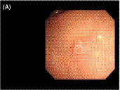 Case of gastric anisakiasis with no symptoms