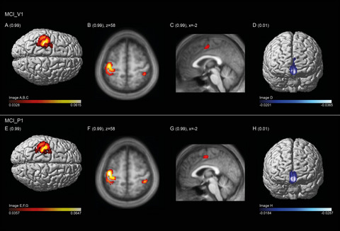 The effect of a single dose of escitalopram on sensorimotor networks