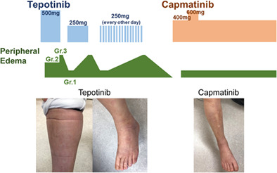Capmatinib successfully overcomes tepotinib-induced intolerable peripheral edema