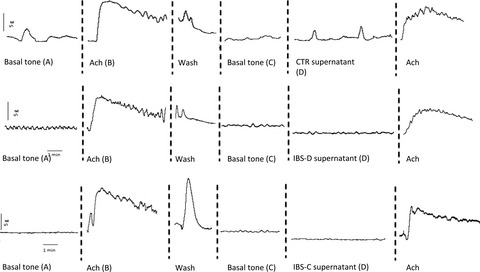 Supernatants of irritable bowel syndrome mucosal biopsies impair human colonic smooth muscle contractility