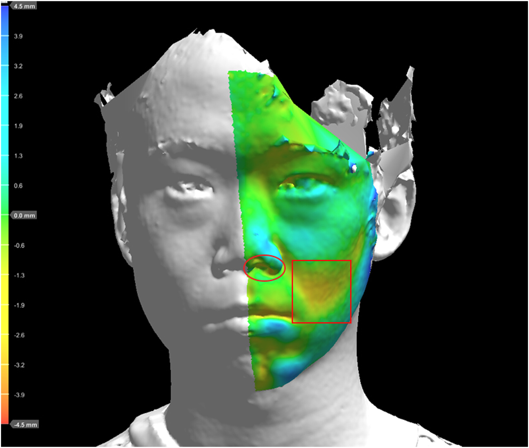 Comparison of 3D facial photographs and clinical documentation in patients with craniofacial morphea