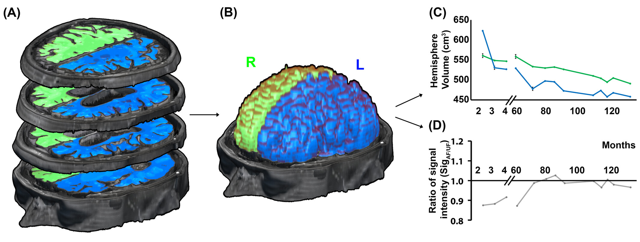 Longitudinal imaging for monitoring disease activity in late-onset Rasmussen's encephalitis during multimodal rehabilitation and immune therapy