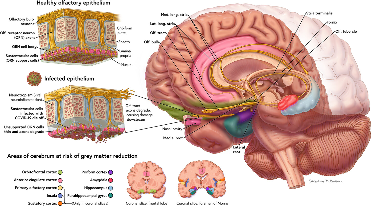 Mechanisms of COVID-19-associated olfactory dysfunction