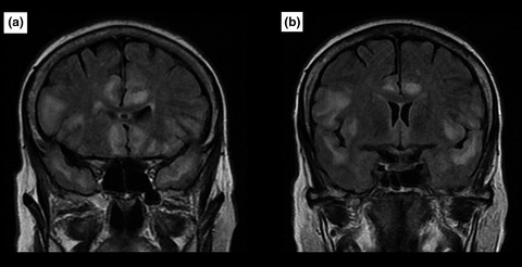 Limbic encephalitis: Experience of a moroccan center