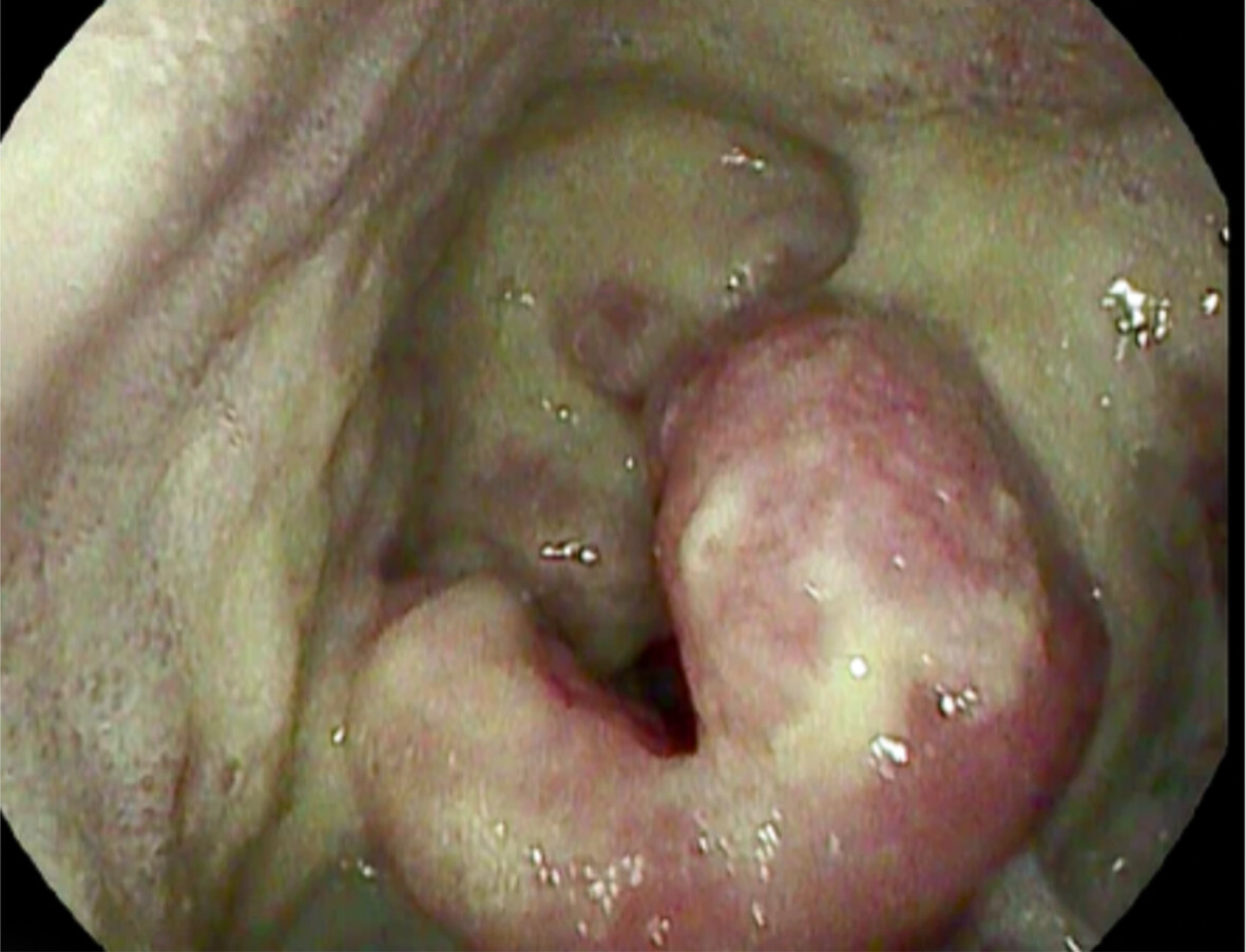 Immune Checkpoint Inhibitor Induced Supraglottitis: A Case Series