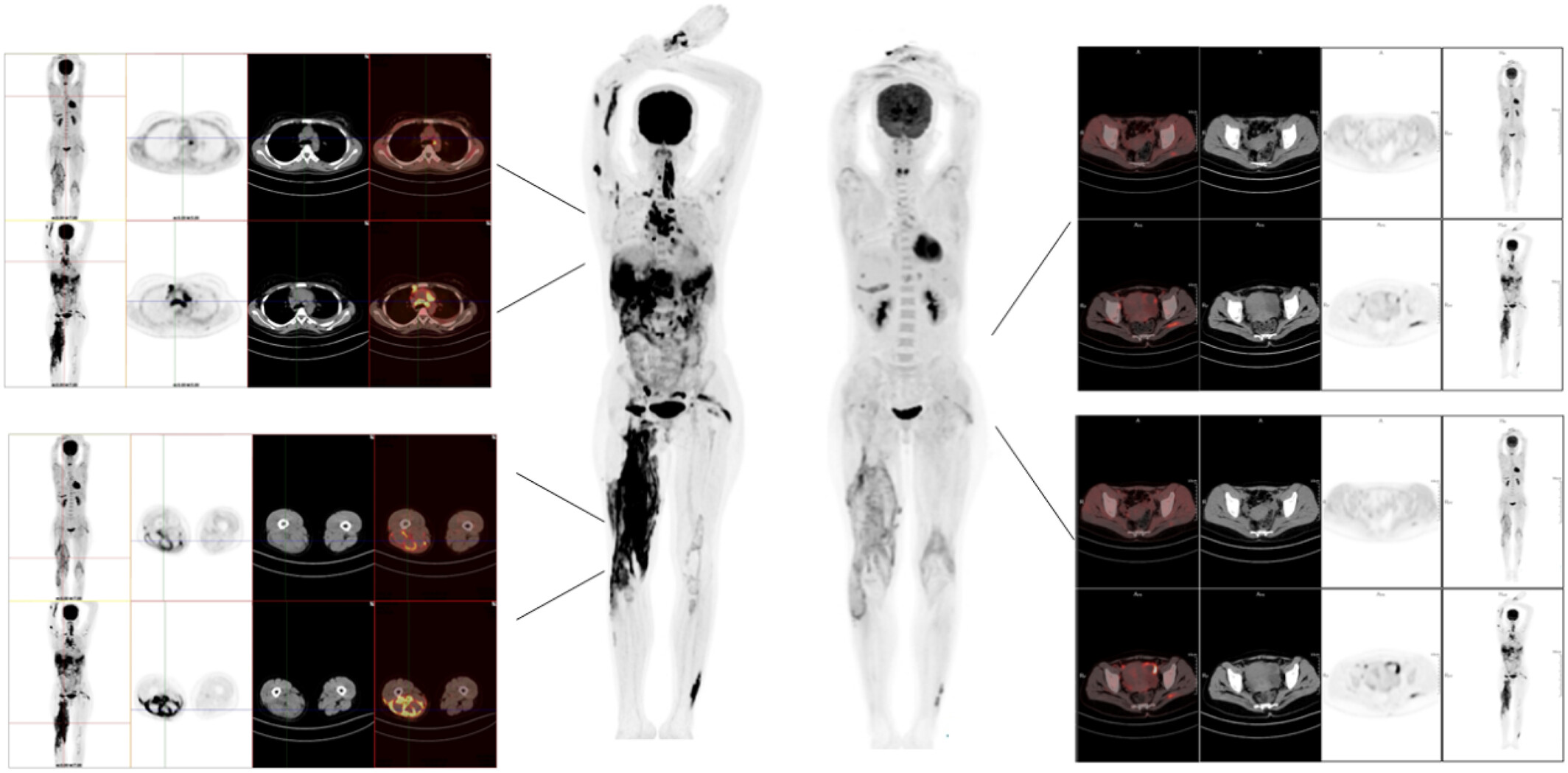 Anti-synthetase syndrome complicated by multifocal tuberculosis: A thought-provoking differential diagnosis with tumors