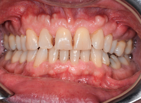 Oral maxillary exostosis