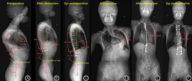Characteristics of Sagittal Alignment in Patients with Severe and Rigid Scoliosis