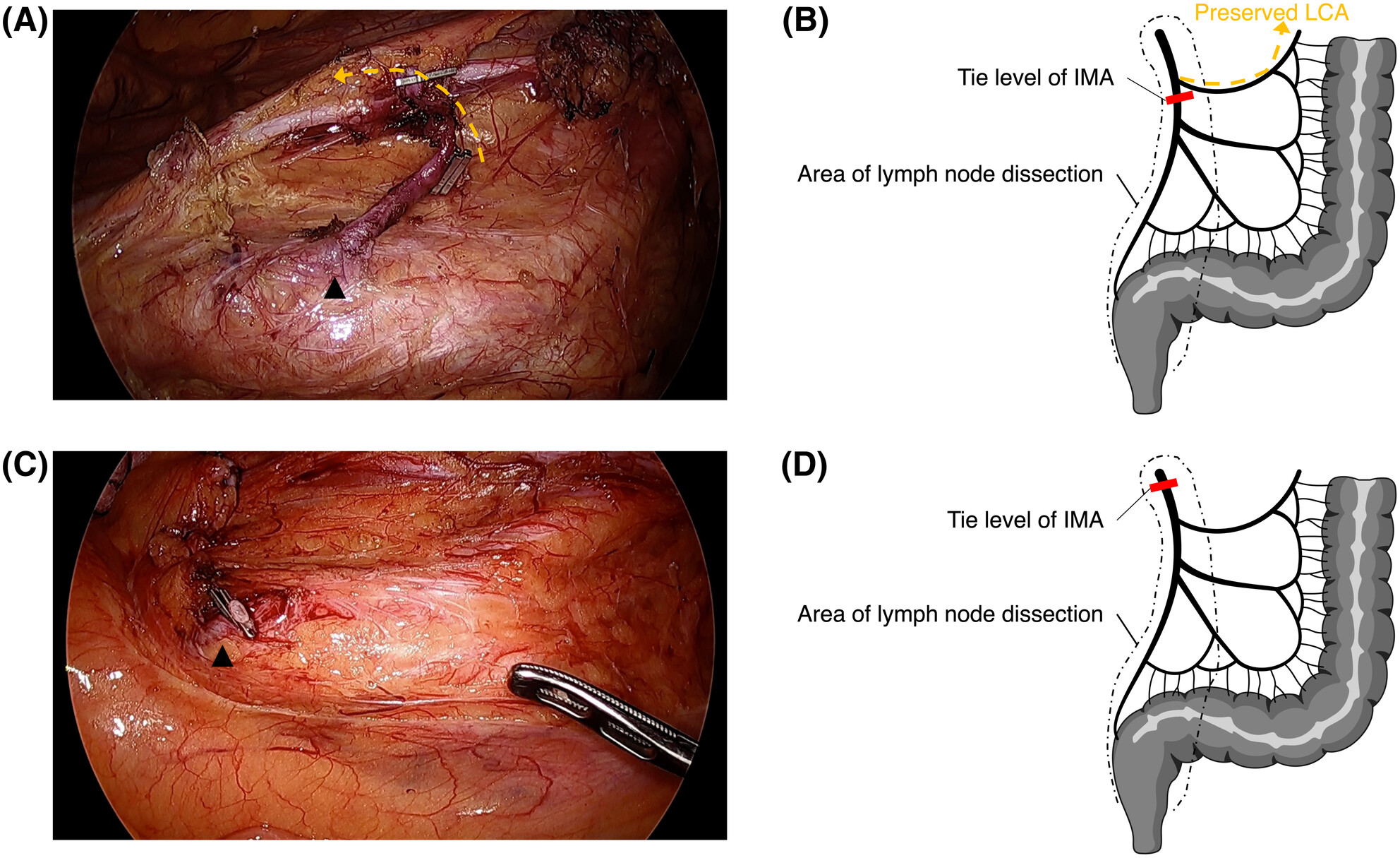 Efficacy of lymph node dissection around the inferior mesenteric artery with preservation of the left colic artery for rectal cancer