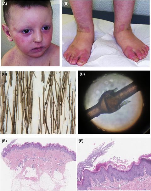 Netherton syndrome plus atopic dermatitis: Two new genetic mutations in the same patient