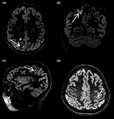 Correlation between cortical lesions and cognitive impairment in multiple sclerosis