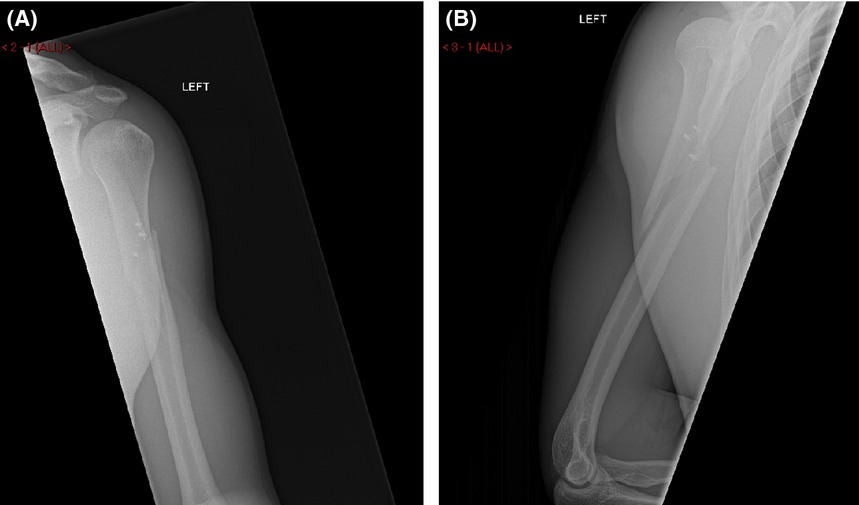 A case report of periprosthetic fracture left proximal humerus with radial nerve palsy following pectoralis major repair