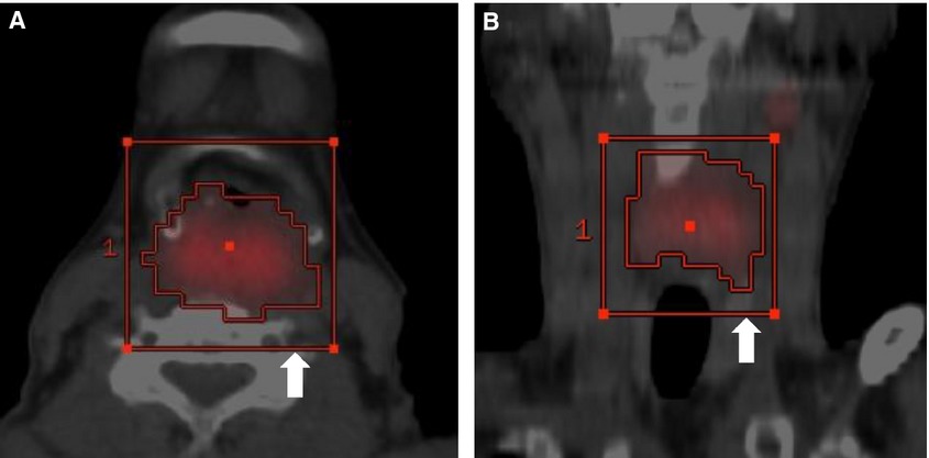 Volumetric PET/CT parameters predict local response of head and neck squamous cell carcinoma to chemoradiotherapy