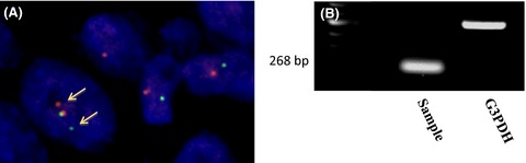 Diagnosis of desmoplastic small-round-cell tumor by cytogenetic analysis: a case report