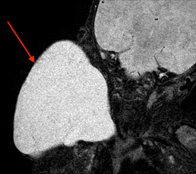 Current status, pitfalls and future directions in the diagnosis and therapy of lymphatic malformation
