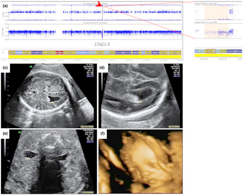 Prenatal ultrasound findings in Koolen-de Vries foetuses: Central nervous system anomalies are frequent markers of this syndrome