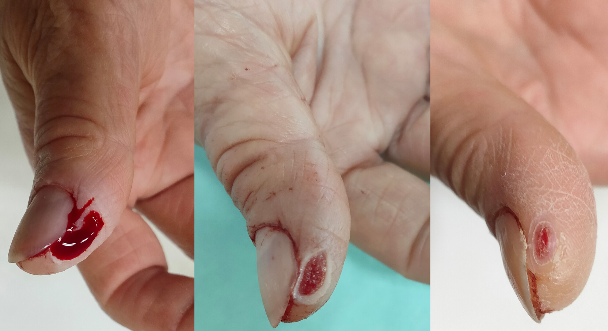 Hemostatic technique using cyanoacrylate for fingertip cut injury: A review of 21 cases
