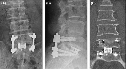 Successful salvage surgery for failed transforaminal lumbosacral interbody fusion using the anterior transperitoneal approach