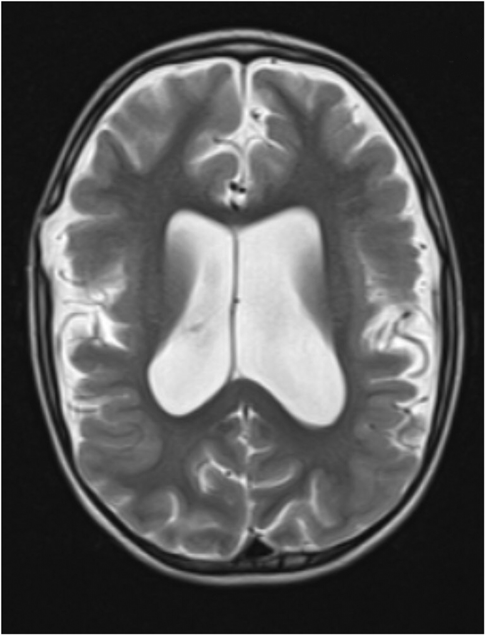 Type 1 early infantile epileptic encephalopathy: A case report and literature review