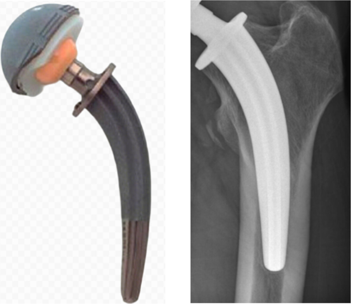 Is Collum Femoris Preserving Stem (CFP) an Epiphyseal-Stabilized Prosthesis? A Long-Term Single-Center Series Follow Up of 705 Cases Issue ,
