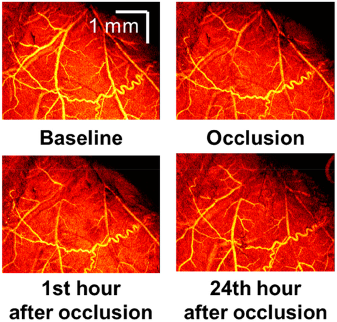 Optical coherence tomography angiography for mapping cerebral microvasculature based on normalized differentiation analysis