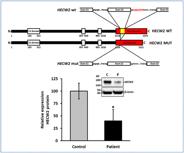 First splicing variant in HECW2 with an autosomal recessive pattern of inheritance and associated with NDHSAL