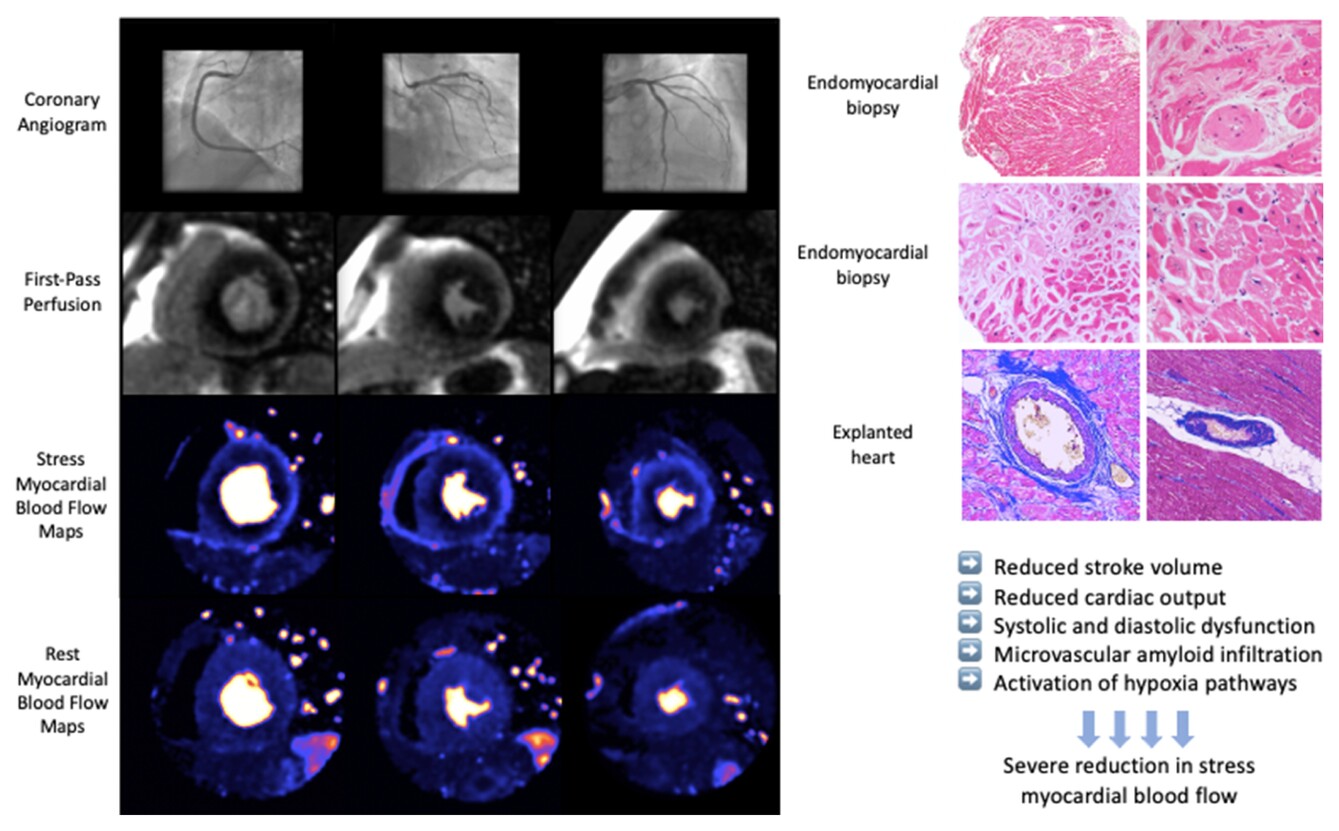 Myocardial perfusion in cardiac amyloidosis