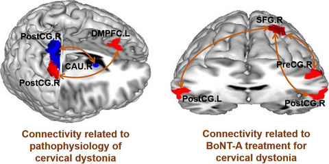 Brain connectivity abnormalities and treatment-induced restorations in patients with cervical dystonia