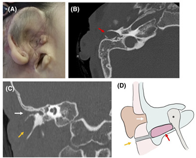 Congenital aural atresia and first branchial cleft anomalies: Cholesteatoma and surgical management