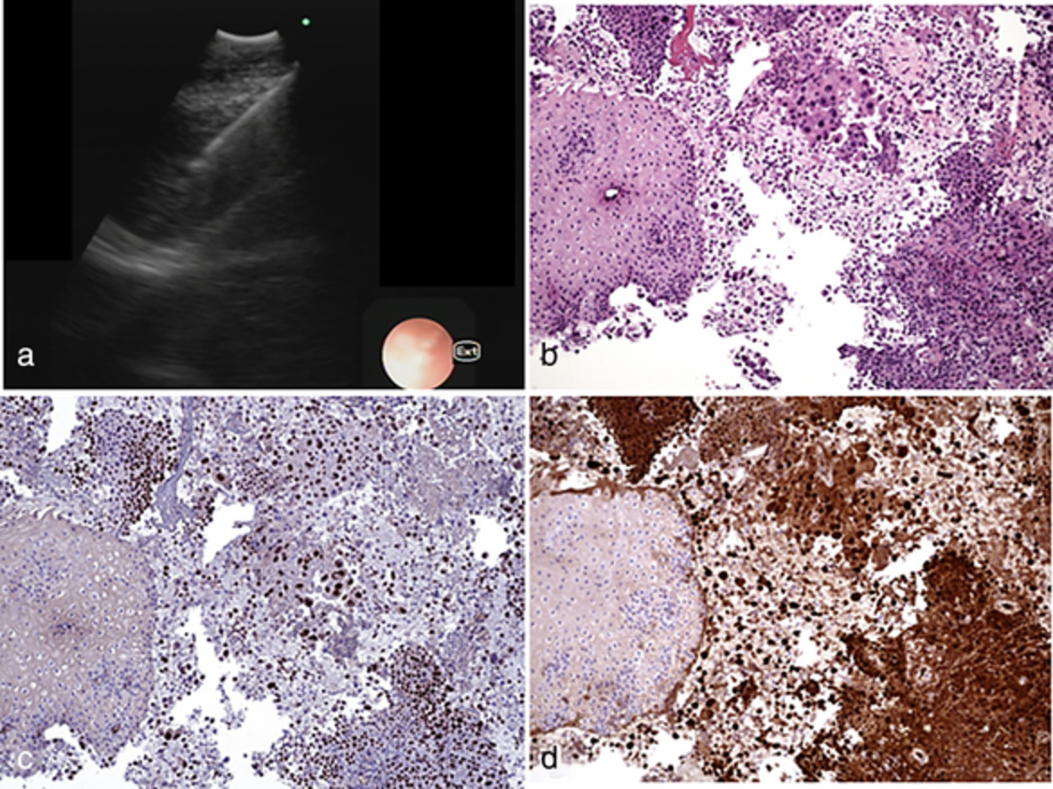 Pleural mesothelioma: When echo-endoscopy (EUS-B-FNA) leads to diagnosis in a minimally invasive way