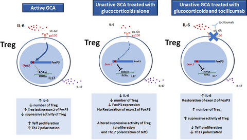 Improvement of Treg immune response after treatment with tocilizumab in giant cell arteritis