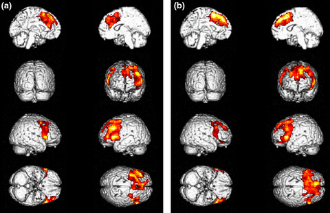 Brain metabolic correlates of apathy in amyotrophic lateral sclerosis: An 18F-FDG-positron emission tomography stud