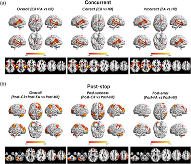 Distinct and temporally associated neural mechanisms underlying concurrent, postsuccess, and posterror cognitive controls: Evidence from a stop-signal task