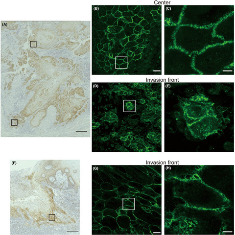 Intracellular claudin-1 at the invasive front of tongue squamous cell carcinoma is associated with lymph node metastasis