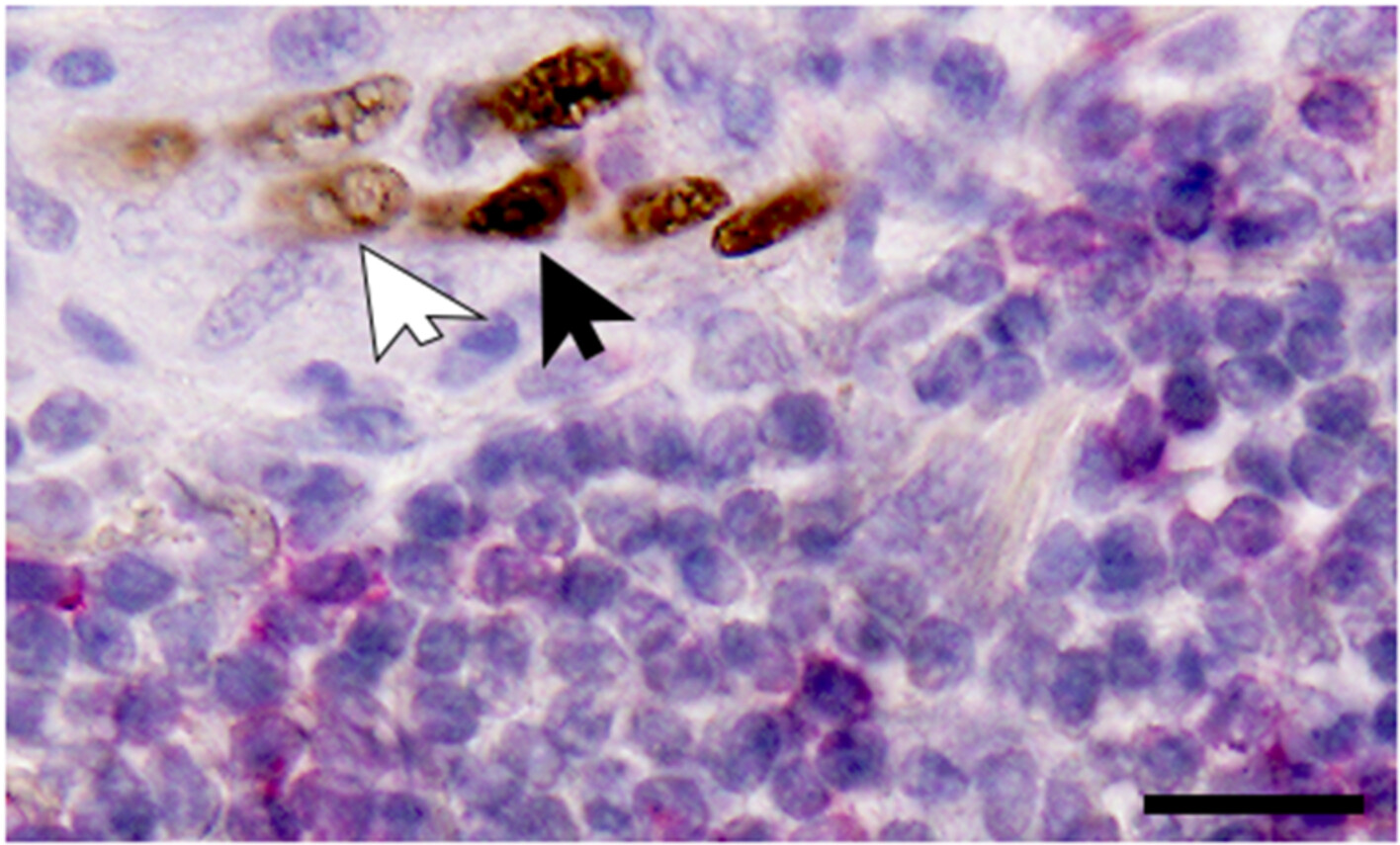 SOX17 expression in tumor-penetrating vessels in relation to CD8+ T-cell infiltration in cancer stroma niches