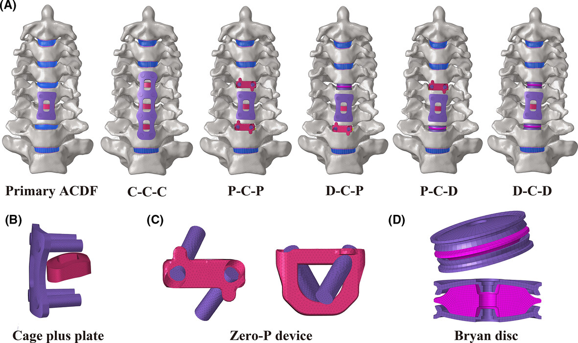Finite element analysis of two-level discontinuous cervical hybrid revision surgery strategy to reduce biomechanical responses of adjacent segments