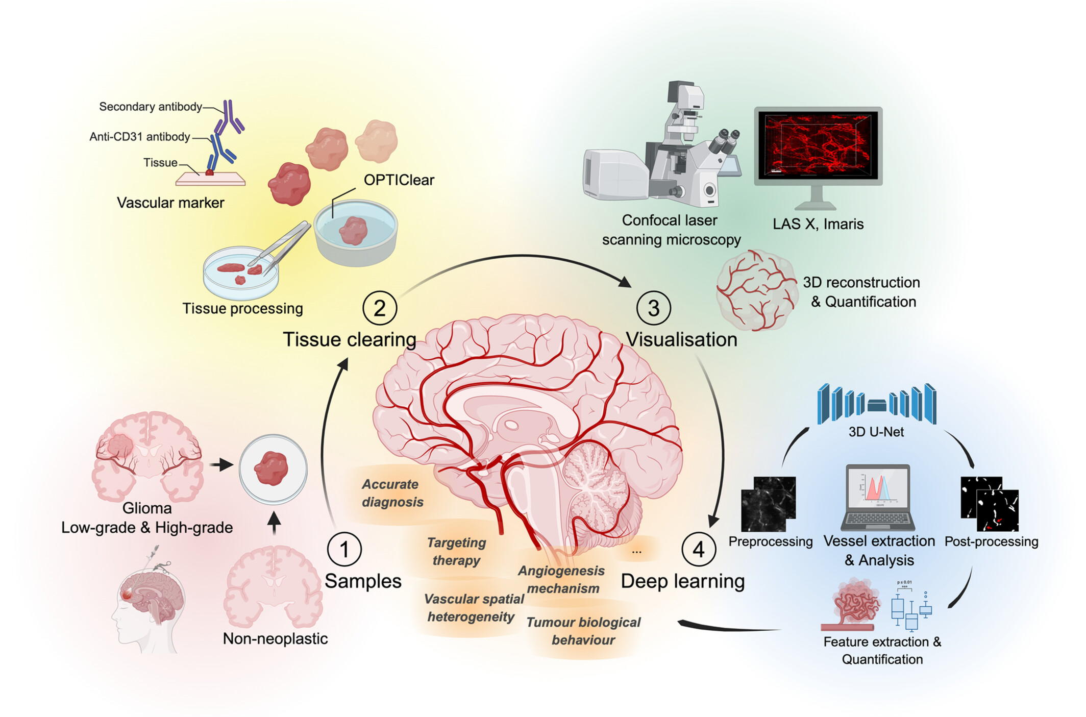 Three-Dimensional Visualisation of Blood Vessels in Human Gliomas Using Tissue Clearing and Deep Learning