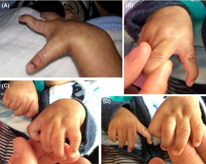 2q31.1 microdeletion syndrome: case report and literature review