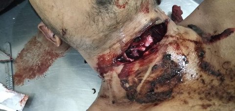 Suicidal cut-throat wound during LSD intoxication Issue 11, 2021