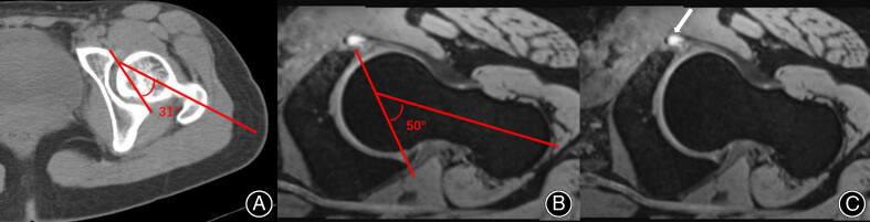 Hip Pain after Distal Femoral Derotational Osteotomy for a Patient with Patellar Instability: A Case Report