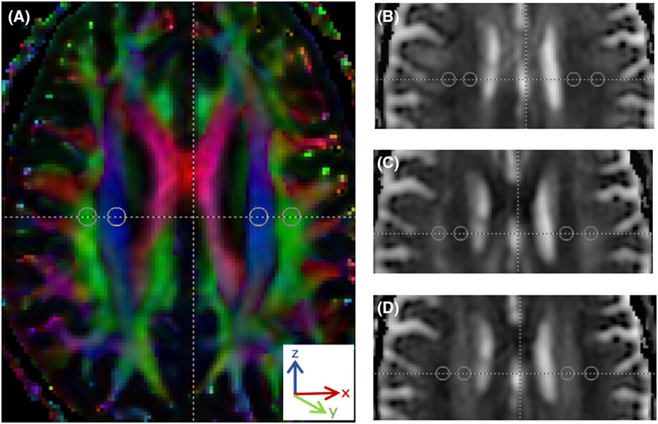 Diffusion along perivascular spaces provides evidence interlinking compromised glymphatic function with aging in Parkinson's disease