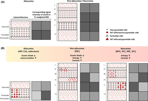Associations between texture of T1-weighted magnetic resonance imaging and radiographic pathologies in Alzheimer’s disease