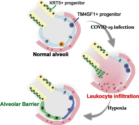 Single-cell analysis identified lung progenitor cells in COVID-19 patients