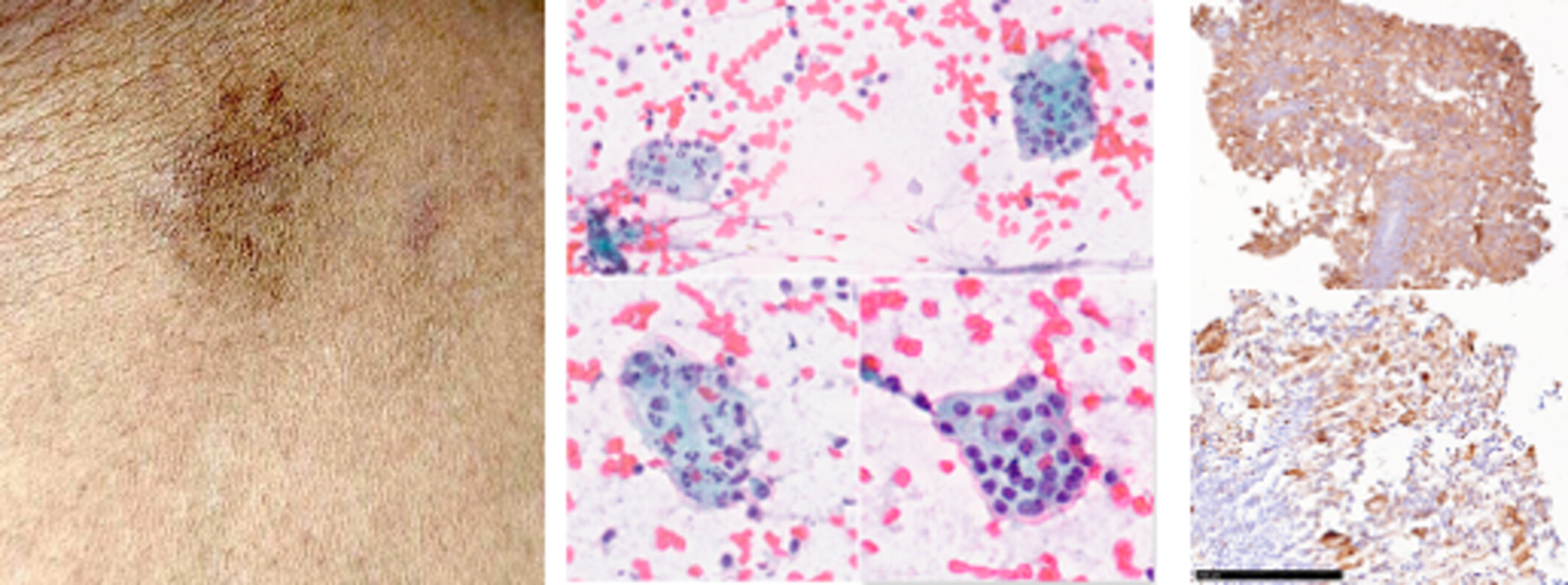 Primary Cutaneous Rosai–Dorfman Disease in a Treated Case of Breast Carcinoma—Cytological Diagnostic Enigma
