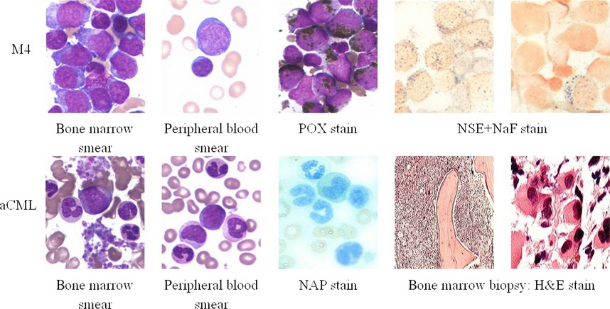 A novel mutation of SETBP1 in atypical chronic myeloid leukemia transformed from acute myelomonocytic leukemia