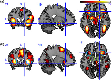 Questioning the role of amygdala and insula in an attentional capture by emotional stimuli task