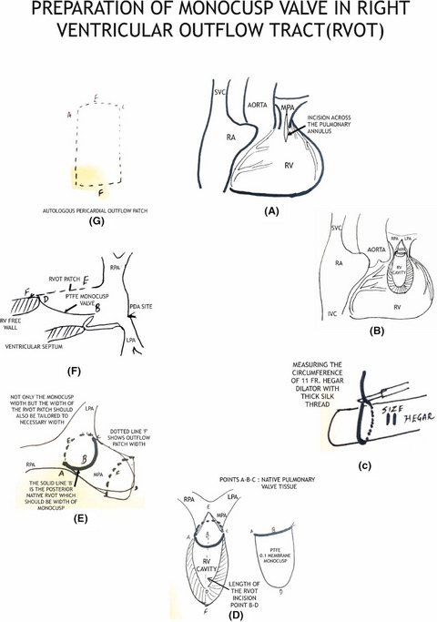 Higher pulmonary vein index on computed angiography and optimum surgical resection ensures smooth postoperative recovery in Fallot's tetralogy: Special emphasis on indices of evaluation and Monocusp preparation